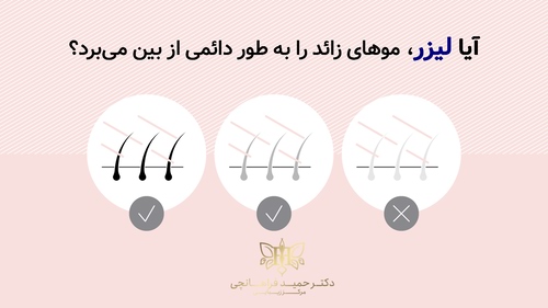 آیا لیزر موهای زائد را دائمی از بین می برد؟