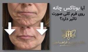 آیا بوتاکس چانه روی فرم کلی صورت تاثیر دارد؟