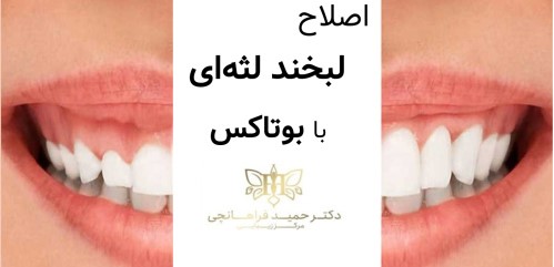 اصلاح لبخند لثه‌ با بوتاکس