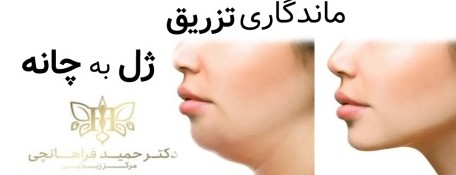 تزریق ژل و ماندگاري آن به چانه به عوامل مختلفی بستگی دارد.