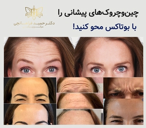 چین و چروک های پیشانی را با بوتاکس محو کنید!