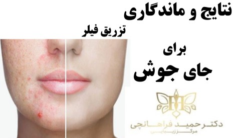 تزریق فیلر برای جای جوش پس از مدتي نياز به تكرار دارد.