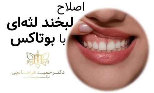 با بوتاکس اصلاح لبخند لثه‌ای زيبايي خود را دوچندان كنيد.