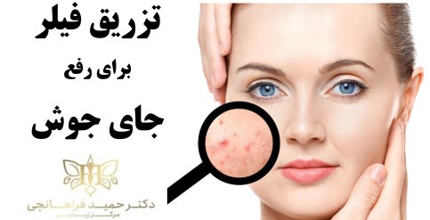 تزریق فیلر برای رفع جای جوش ها