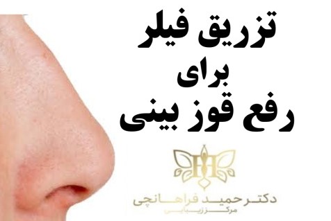 تزریق فیلر برای قوزبيني