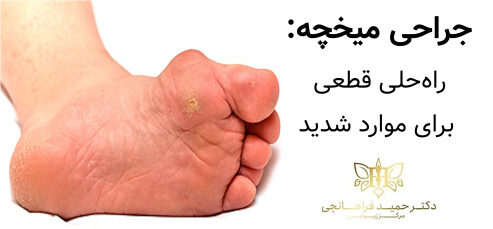 جراحی میخچه – راه‌حلی قطعی برای موارد شدید