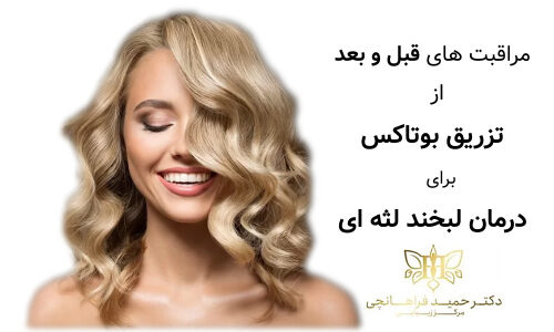 مراقبت های قبل و بعد از تزریق بوتاکس برای درمان لبخند لثه ای