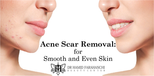 Acne Scar Removal The Best Treatments for Smooth and Even Skin