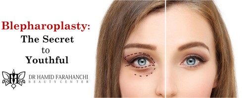 Blepharoplasty The Secret to Youthful