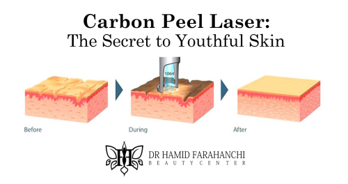 Carbon Peel Laser The Secret to Radiant, Clear and Youthful Skin