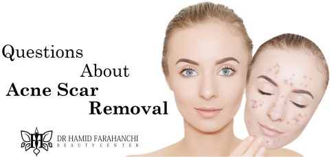 Frequently Asked Questions About Acne Scar Removal