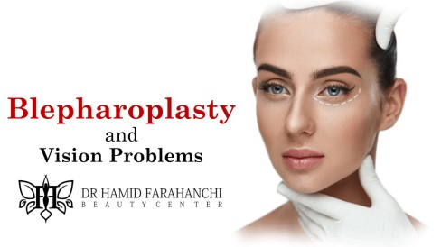 How Blepharoplasty Can Help with Vision Problems Caused by Drooping Eyelids