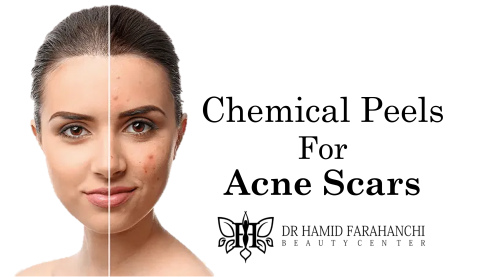 How Chemical Peels Can Help Fade Acne Scars and Improve Skin Texture