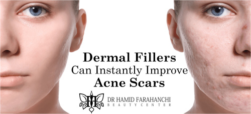 How Dermal Fillers Can Instantly Improve Depressed Acne Scars