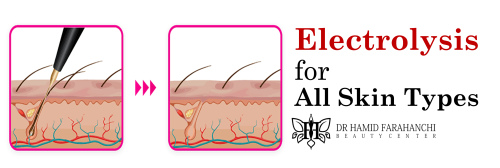 How Electrolysis Helps with Hair Removal for All Skin Types