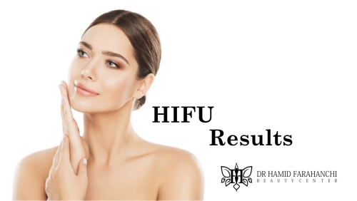 How Long Do HIFU Therapy Results Last Maintaining Your Youthful Skin