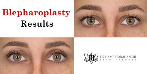 How Long Do the Results of Blepharoplasty Last Maintaining Your Youthful Eyes