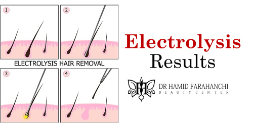Long-Term Results How Electrolysis Permanently Removes White Hair