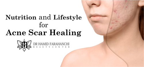 The Role of Nutrition and Lifestyle in Acne Scar Healing