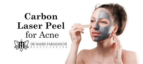 The Top Benefits of Carbon Laser Peel for Acne, Pigmentation, and Skin Rejuvenation