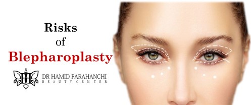 What Are the Risks and Recovery Time for Blepharoplasty