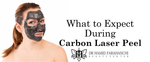 What to Expect During and After a Carbon Laser Peel Session