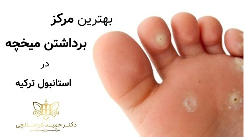 بهترین مرکز برداشتن میخچه در استانبول ترکیه