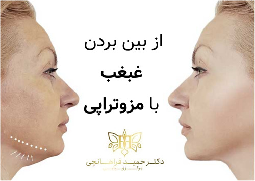 رفع غبغب با مزوتراپی