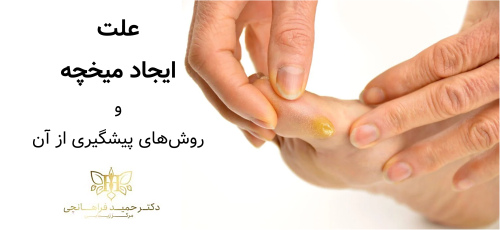 علت ایجاد میخچه و روش‌های پیشگیری از آن