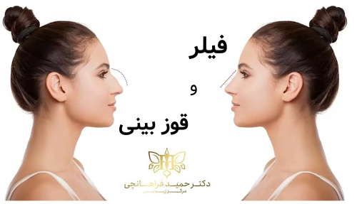 فیلر و قوز بینی