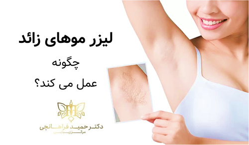 لیزر موهای زائد چگونه عمل می‌کند؟