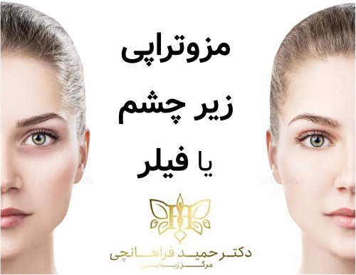 مزوتراپی زیر چشم یا فیلر