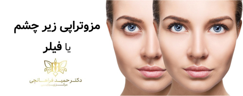 مزوتراپی زیر چشم یا فیلر؟