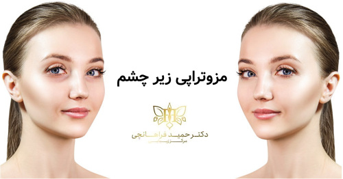 مزوتراپی زیر چشم