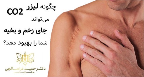 چگونه لیزر CO2 می‌تواند جای زخم و بخیه شما را بهبود دهد؟