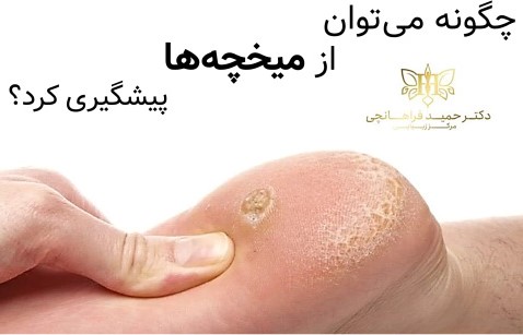 چگونه می‌توان از میخچه‌ها پیشگیری کرد؟