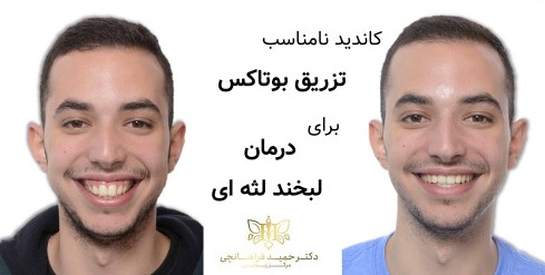 کاندیدای نامناسب تزریق بوتاکس برای درمان لبخند لثه ای
