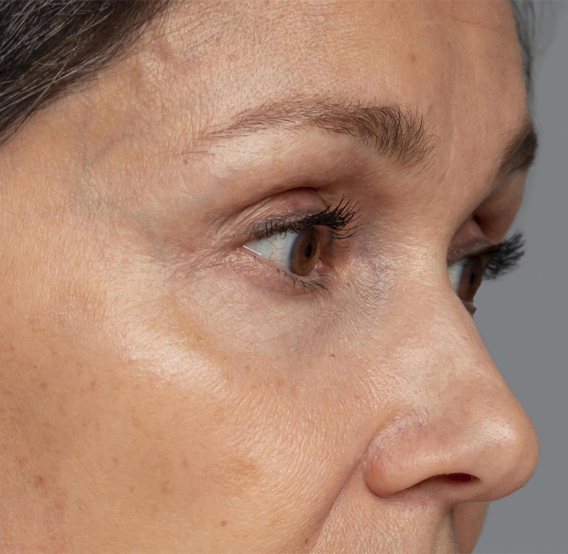 Before Treatment
